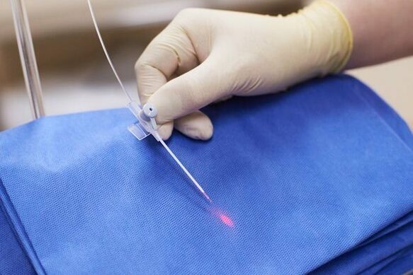 A verschiddene Fäll gëtt Lasertherapie fir chronesch Prostatitis benotzt