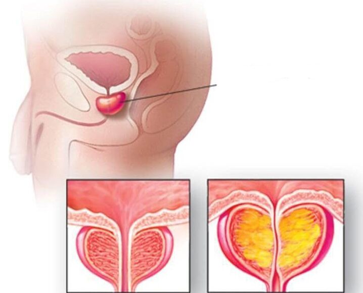 Plaz vun der Prostata, normaler Prostata a vergréissert bei chronescher Prostatitis