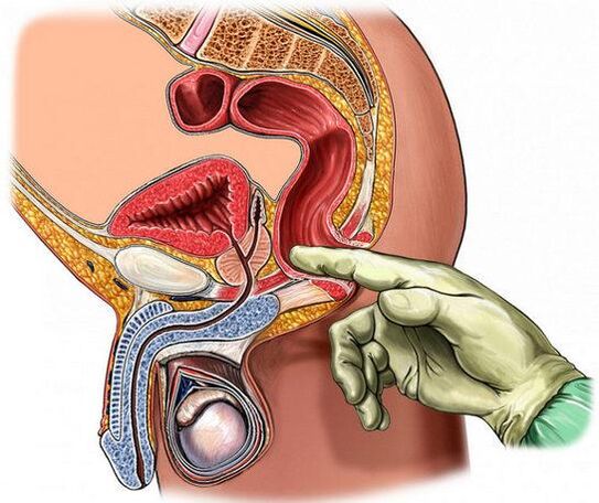 Diagnos vum Prostatitis