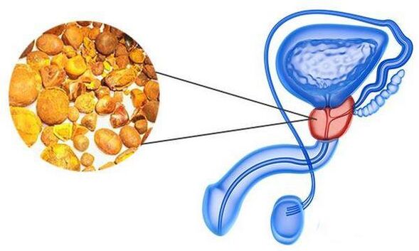 Problemer mat Prostatitis