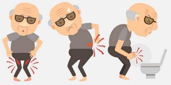 Symptomer vun Prostatitis