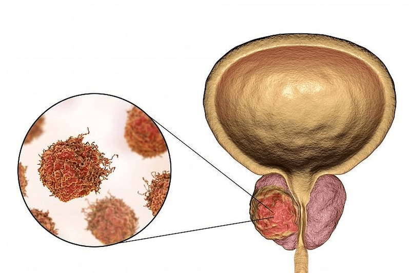 wéi gesäit Prostata Schued aus