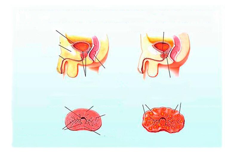 Unzeeche vu chronescher Prostatitis