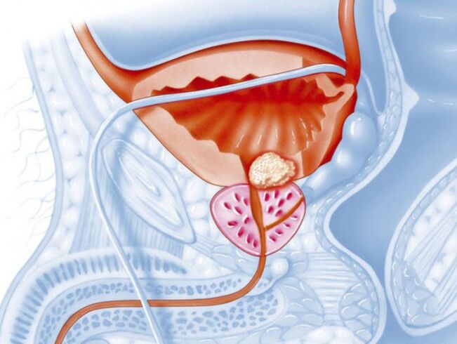 Bakteriell Prostatitis