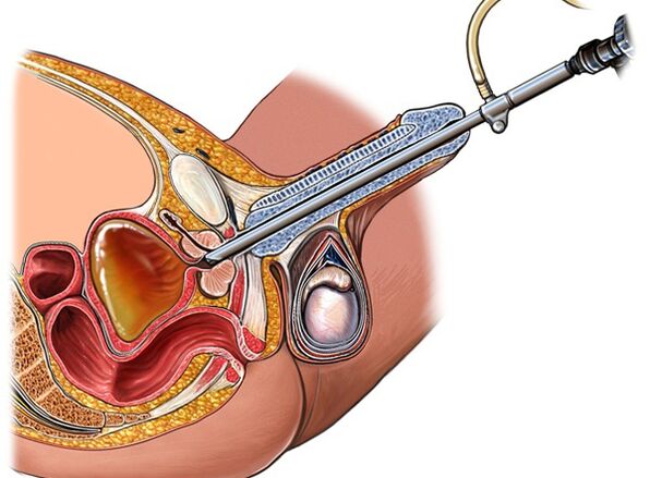 Behandlung vun Prostatitis