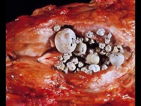 Berechnung prostatitis