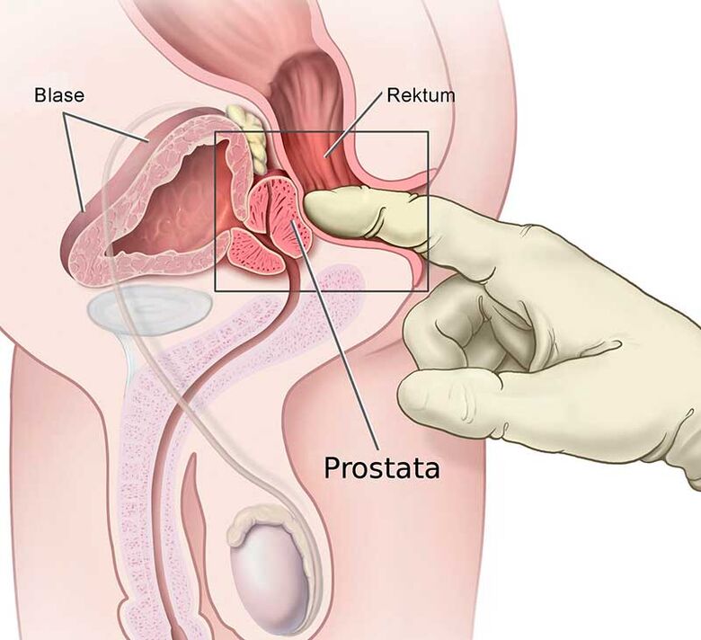 Prostata Massage fir Prostatitis