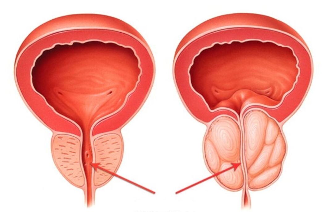gesond an entzündete Prostata mat Prostatitis