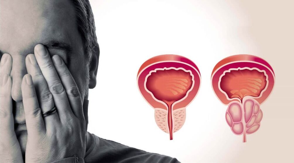 Gesond an entzündegt Prostata